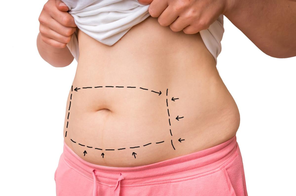 Do You Need Diastasis Recti Surgery?