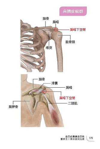 夾擠症候群