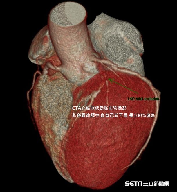 心肌梗塞通常是因為供應心臟養分的冠狀動脈產生斑塊堆積，在血管內皮中造成阻塞，進而造成心肌的缺氧和胸悶胸痛，嚴重時會猝死。（示意圖／資料照）