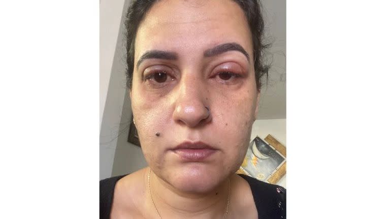 Tres horas después del procedimiento, Valéria Campos notó que sus párpados estaban rojos, hinchados y doloridos