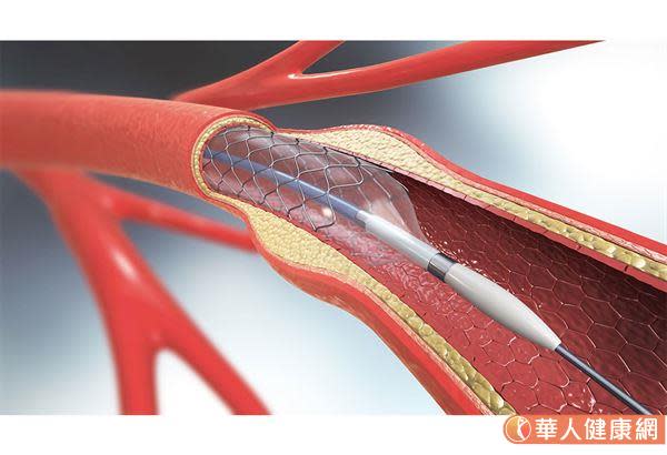國泰綜合醫院心血管中心介入性心血管科主治醫師張嘉修表示，冠狀動脈支架植入手術，是目前改善冠狀動脈血流及病人心絞痛最有效的方法之一。