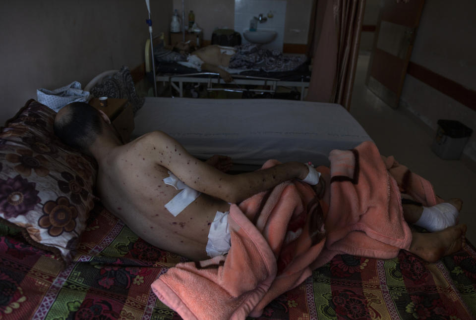 Sharif Al-zaharna, 33, rests at the Shifa hospital in Gaza City, Thursday, May 13, 2021, where he is receiving treatment for wounds caused by a May 10 Israeli strike that hit a nearby his family house in town of Jabaliya. Just weeks ago, the Gaza Strip’s feeble health care system was struggling with a runaway surge of coronavirus cases. Now doctors across the crowded coastal enclave are trying to keep up with a very different crisis: blast and shrapnel wounds, cuts and amputations. (AP Photo/Khalil Hamra)