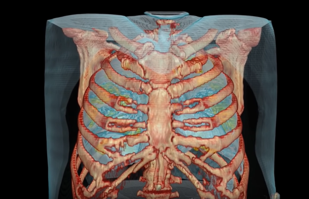 喬治華盛頓大學醫院利用電腦斷層掃描成像技術，製作出武漢肺炎患者的肺部影像。   圖：擷取自 「Aalap Herur-Raman」YouTube
