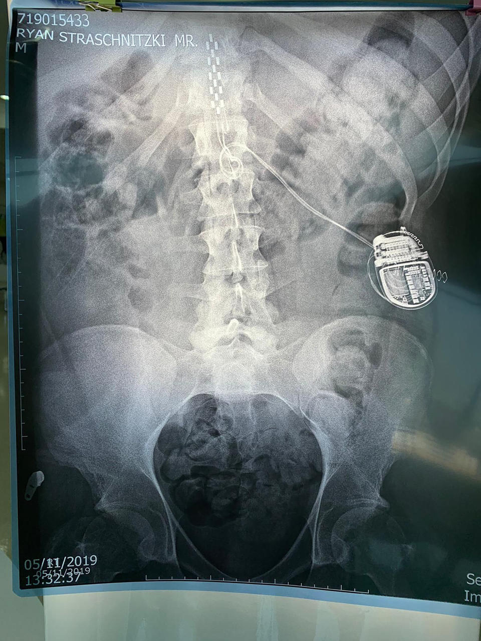 This Nov. 5, 2019, photo provided by Tom Straschnitzki shows an X-ray film image of the spine and a stimulator surgically implanted in the back of Ryan Straschnitzki in Bangkok, Thailand. Ryan was left paralyzed from the chest down after the bus carrying his Humboldt Broncos hockey team collided with a truck at a rural intersection in Canada 17 months ago. The former hockey prospect went to Thailand to have a stimulator implanted in his back so electrical currents can communicate with his nerves. He took his first small steps and hopes for a better life. (Tom Straschnitzki/ via AP)