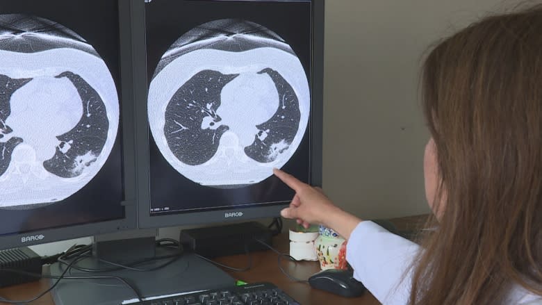 Doctor's diagnosis leads her to push harder for early lung cancer screening