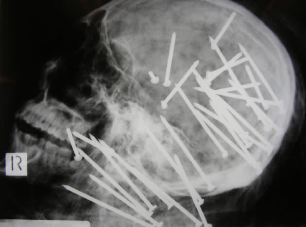 In this undated photo released by the New South Wales Police on Friday, April 24, 2009, an X-ray image of the skull of Chinese man Chen Liu is shown. Liu's badly decomposed body was found in marshland in Sydney's south, Nov. 1 2008, after being shot repeatedly in the head with a high-powered nail gun. (AP Photo/New South Wales Police, HO)