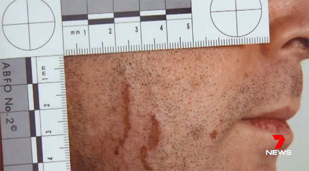 Seven News can reveal the scars on Baden-Clay's cheeks from Allison's fingernails have now faded. Photo: 7 News