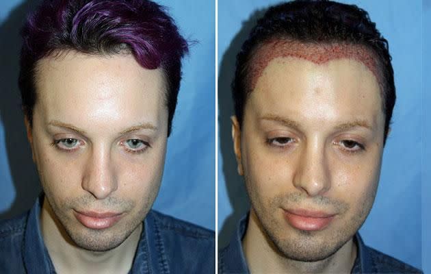 Luis' latest procedure gave him a dracula hairline. Photo: Caters news