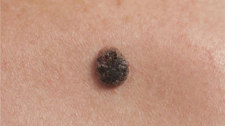 El síntoma más común del melanoma es la aparición de un nuevo lunar o la presencia de cambios en uno ya existente.