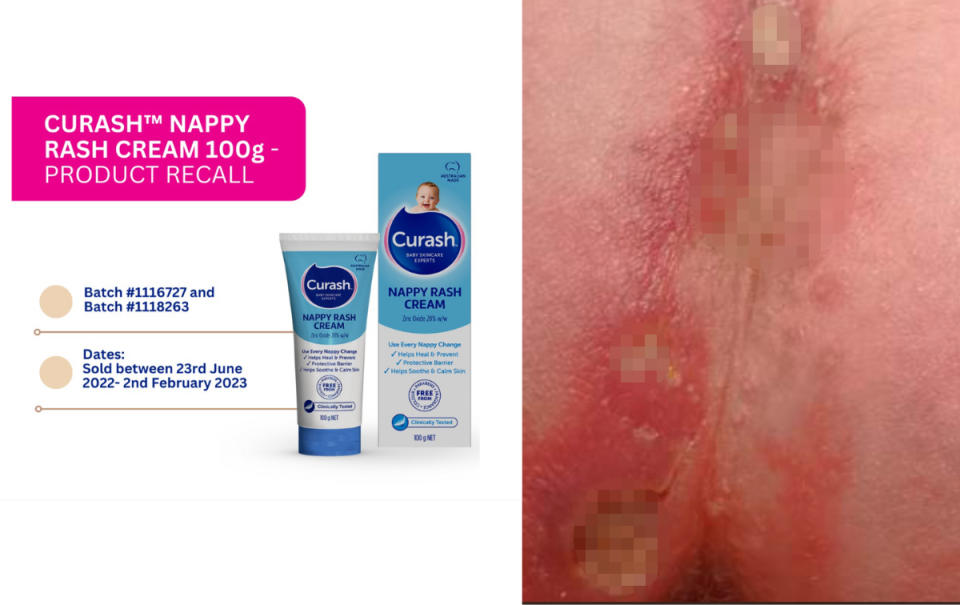 Curash nappy rash cream recall notice; blisters on baby girl