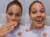 En juin dernier, un accident peu banal est arrivé à Ashley Graham. En voulant croquer dans un cookie encore surgelé, cette dernière s'est cassé une dent. L'incisive plus précisément, qu'elle a dû aller se faire recoller en vitesse chez le dentiste. Le sourire d'Ashley a fort heureusement pu être sauvé par son dentiste après lui avoir posé une prothèse toute neuve. Ne cachant décidément rien à ses fans, la belle n'a pas hésité à relayer cette intervention spectaculaire sur les réseaux sociaux, sans craindre le moins du monde d'abimer son image. (©<em>Instagram/Ashley Graham</em>)