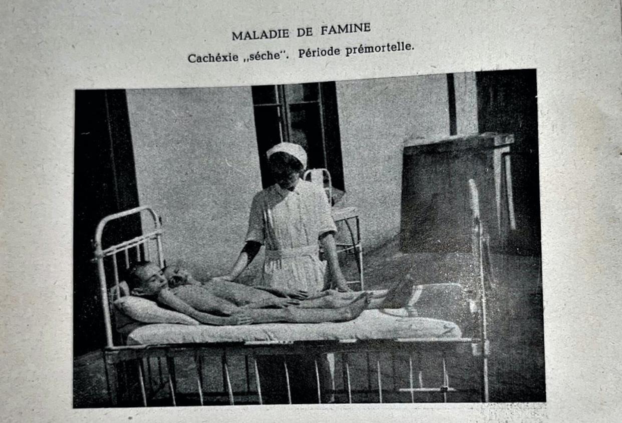 The book includes haunting photos from inside the ghetto, along with its record of the medical effects of starvation. 'Maladie de Famine," American Joint Distribution Committee