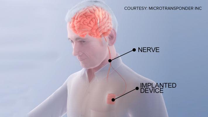 Vagus nerve stimulation (VNS) may play a beneficial role in the motor recovery