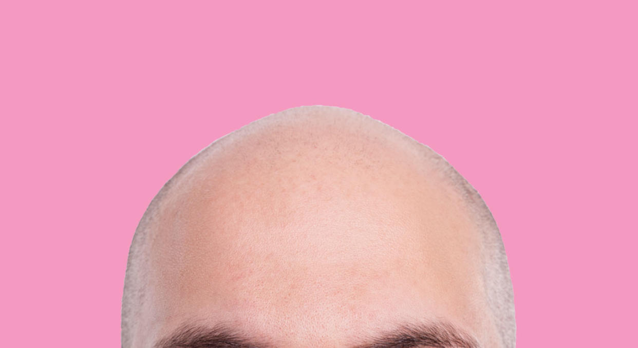 Scientists may have had a breakthrough in the cure for baldness [Photo: Getty]