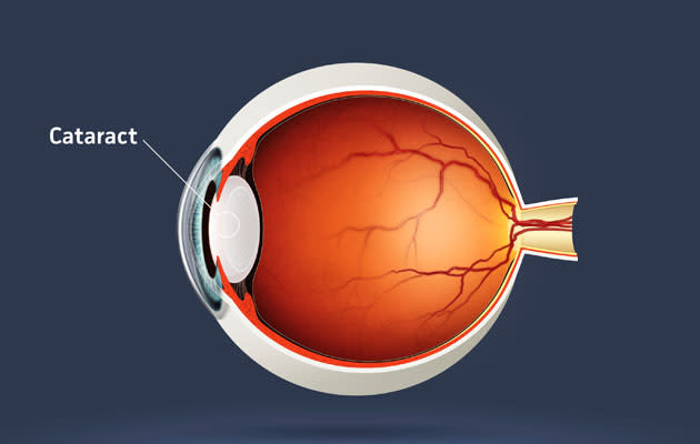 Although anyone can get a cataract, people with diabetes are especially prone to this eye condition.