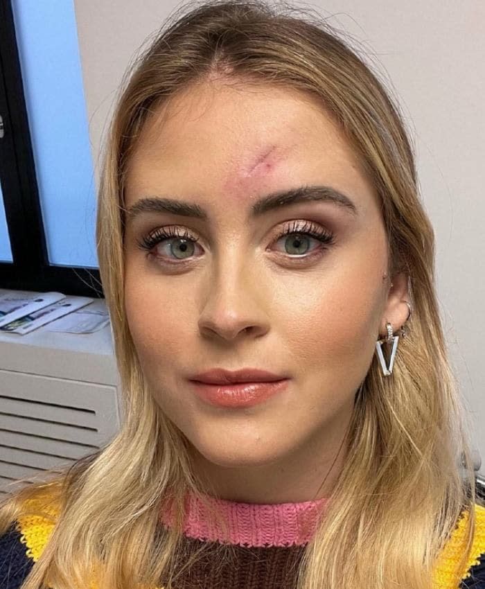 Valentina Ferragni muestra su cicatriz