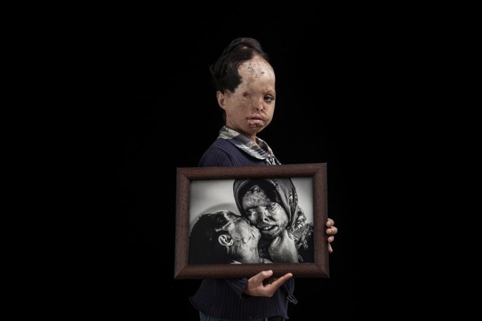 <p>A victim of an acid attack in Iran holds a picture of fellow victims. (Asghar Khamseh/SWPA) </p>