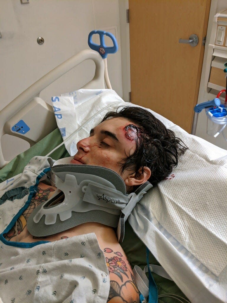 CJ Montano, 24, lies in a hospital bed after getting struck in the head by a rubber bullet at a Los Angeles protest Saturday.