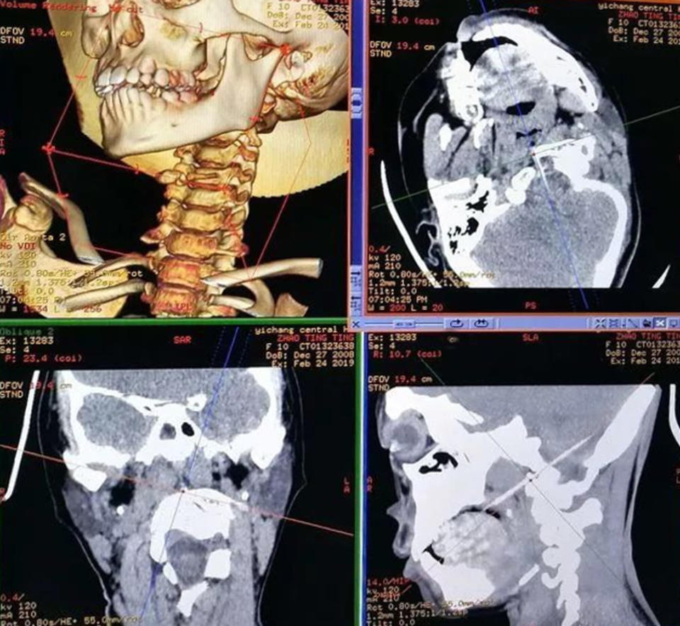 Scans showing the bamboo skewer inside the little girl's head. Source: AsiaWire/Australscope