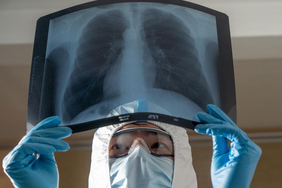 A doctor wearing blue nitrile gloves, a face mask, goggles and a white hood is holding up an x-ray image of someone's chest.