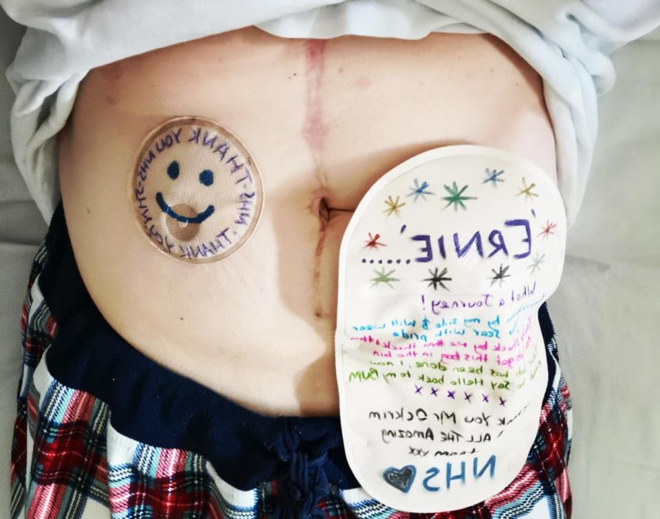 Puplett ended up having two thirds of her colon removed, and a tumour, and also needed a stoma bag. (SWNS)