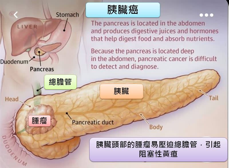 胰臟癌堪稱「癌王」，發現時通常已是晚期，所以病人5年存活率低。（圖／「吃病」台南市立安南醫院副院長許秉毅授權提供）