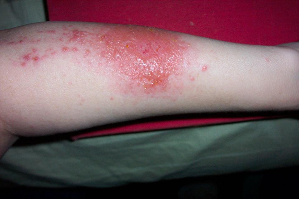 poison ivy rash picture identification