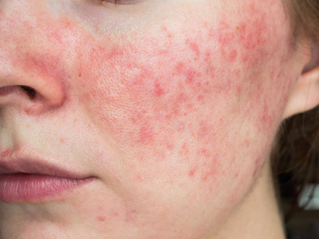 papulopustular rosacea, close-up of the patient's cheek (Yuliya Shauerman / Getty Images)