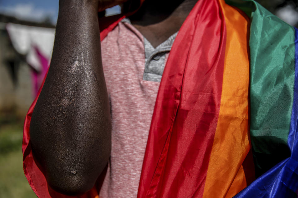 In this photo taken Thursday, June 11, 2020, Ugandan gay refugee Martin Okello shows the scars he suffered in an attack in May, outside the house he shares with other LGBT refugees in Nairobi, Kenya. His life in Uganda was shattered in 2014 when a male sex worker tried to extort him for $10 and outed him as gay. Okello was fired from the Christian radio station where he worked and was kicked out of his home by his Catholic parents. (AP Photo/Brian Inganga)