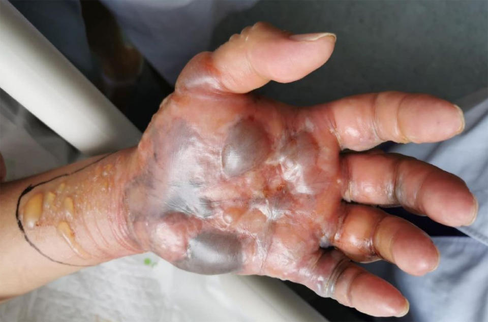 Blisters are seen all over Mr Wang's hand. Source: AsiaWire/Australscope