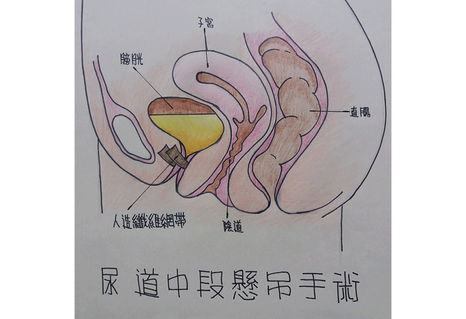 怕尿濕褲子，改穿紙尿褲竟反覆感染…新微創手術擺脫尿失禁