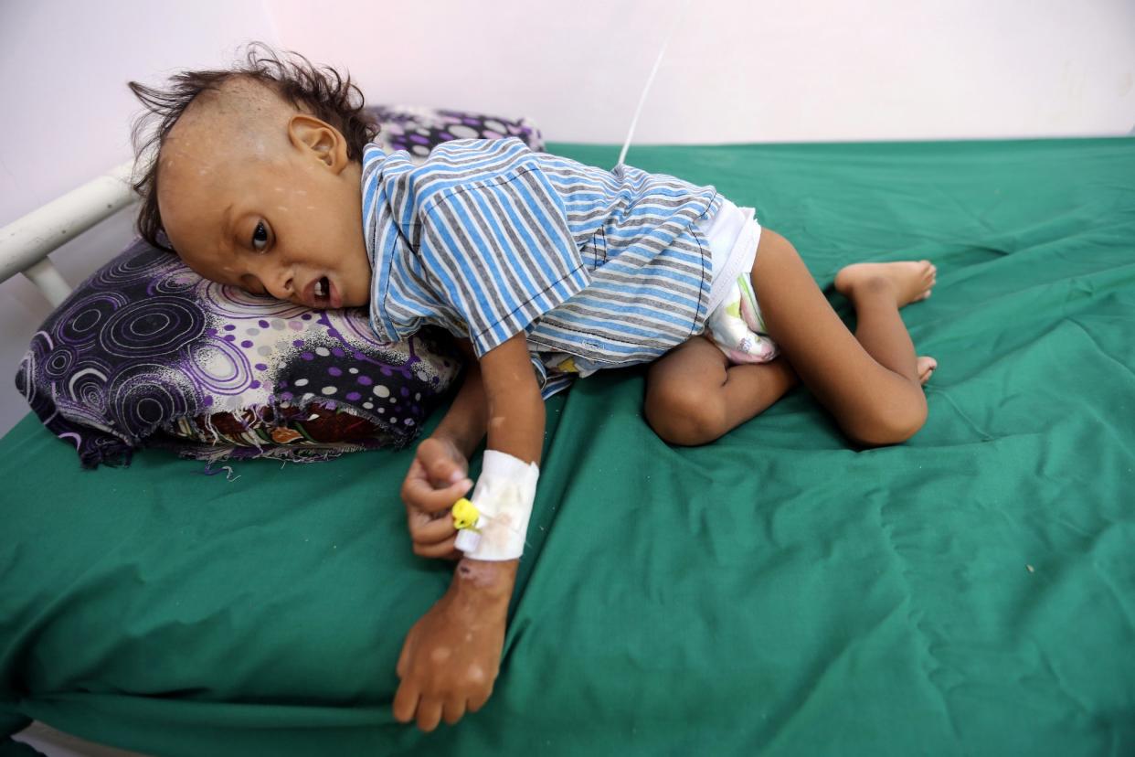 A Yemeni boy, two, is treated for malnutrition earlier this month: Reuters