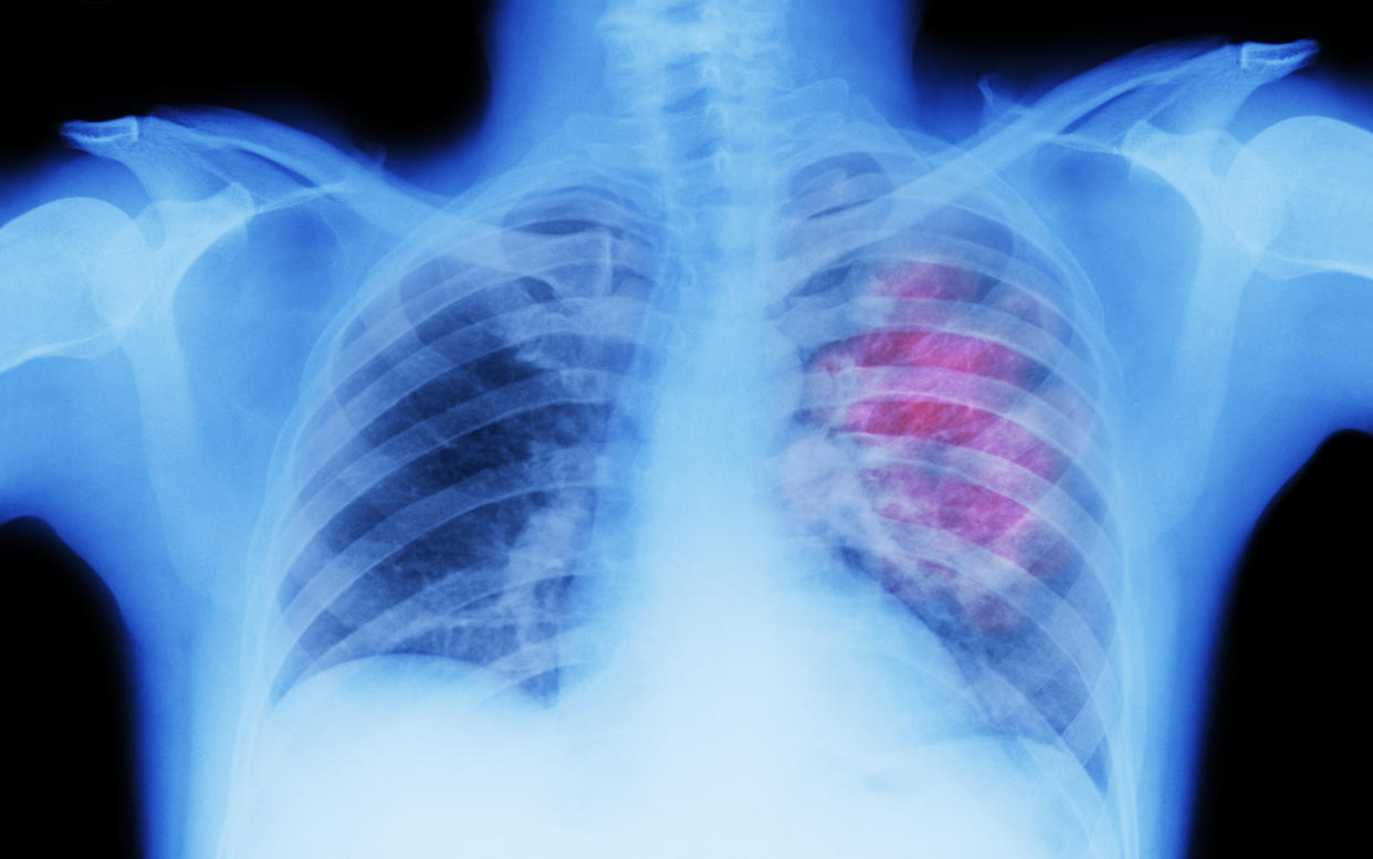 X-ray of lungs showing lung cancer