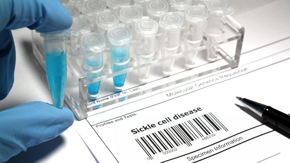 PHOTO: Research for sickle cell disease. (STOCK PHOTO/Getty Images)