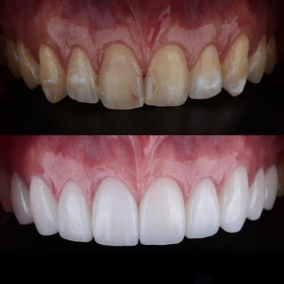 Straight white teeth with porcelain veneers in 1-2 weeks