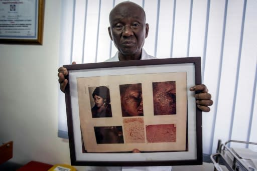 Risk: Edmund Delle, a dermatologist at the Rabito Clinic in Accra, holds up a picture of a woman with ochronosis -- discoloration caused by long-term application of hydroquinone to lighten the skin