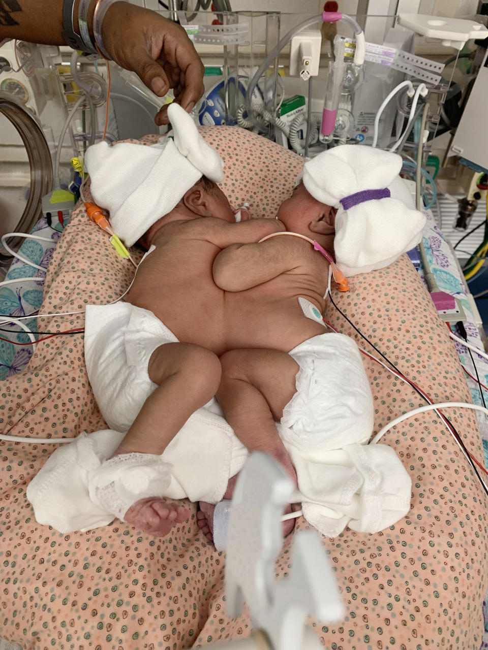 Only one in roughly 200,000 live births results in conjoined twins. (Courtesy Cook Children's Medical Center)