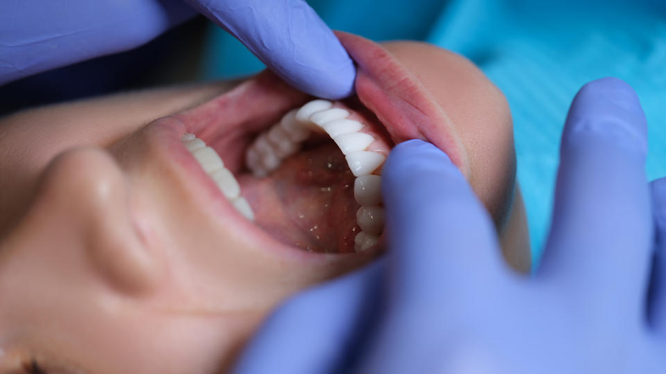 口腔黏膜檢查是篩檢口腔癌的重要工具，政府補助兩類對象每兩年一次免費篩檢。（示意圖／Getty Images）