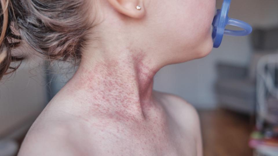baby girl with atopic dermatitis,type of eczema,is an inflammatory