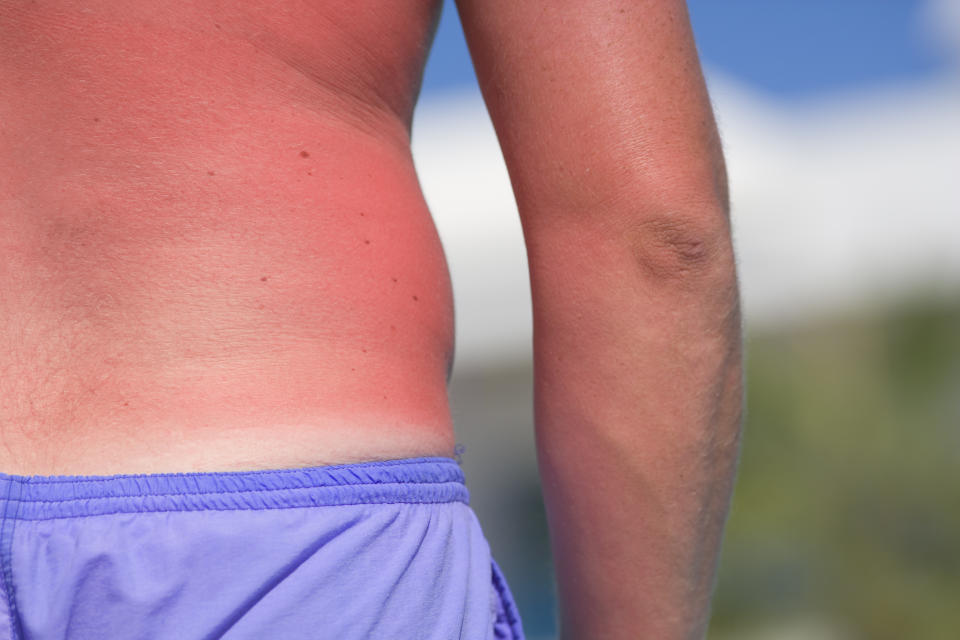 Sonnenbrand kann schmerzhaft sein. (Bild: Getty Images)