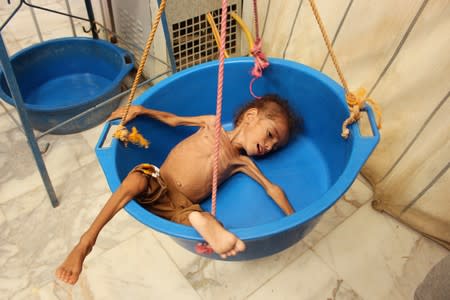 Malnourished Muath Ali Muhammad lies in a weighing scale at a health center in Aslam district of the northwestern province of Hajja