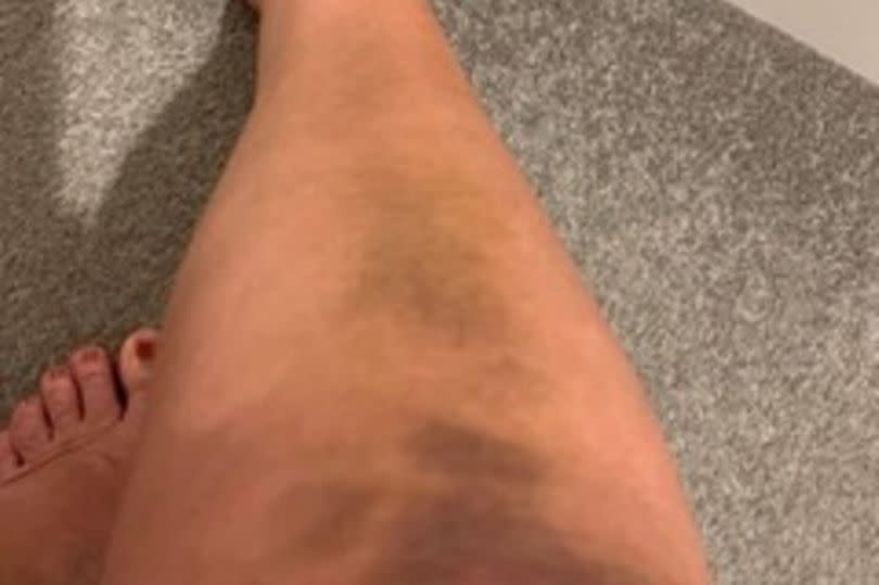 Some of Karen's injuries from her condition, bruises on her legs
