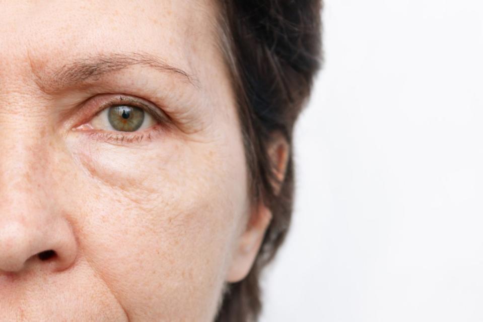 Experiencing mild swelling under your eyes is normal as you age — bags form when you naturally lose the skin-firming proteins collagen and elastin. ÃÅÃÂ°Ãâ¬ÃÂ¸ÃÂ½ÃÂ° ÃâÃÂµÃÂ¼ÃÂµÃËÃÂºÃÂ¾ – stock.adobe.com