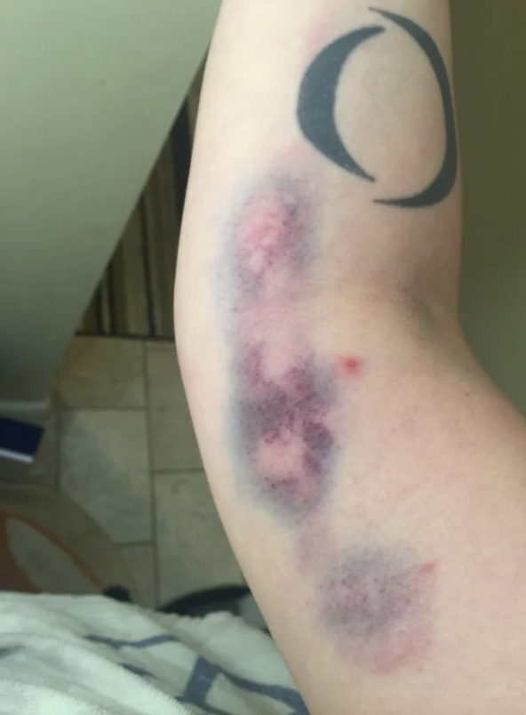 a person's arm covered in bruises