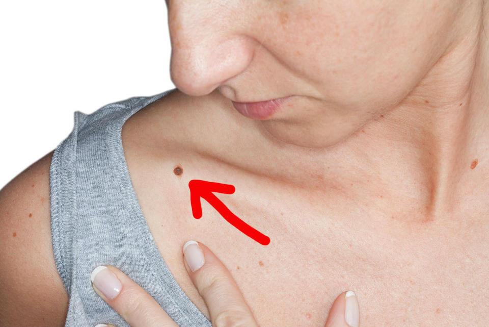 Arrow pointing to a mole on someone's clavicle