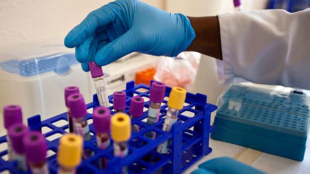 PHOTO: STOCK PHOTO - Blood samples are seen in a lab. (STOCK PHOTO/ Manuel Romaris/Getty Images)