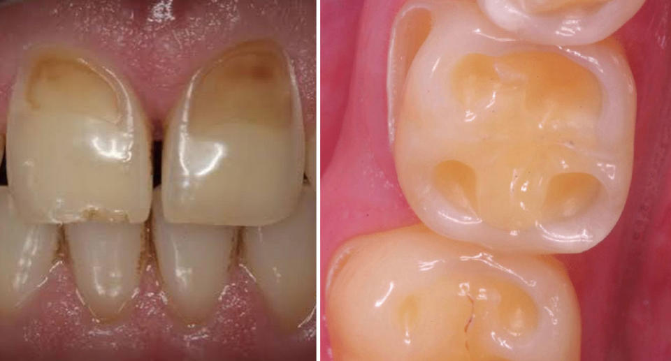 Photos illustrating teeth with signs of damage from too much kombucha shared by Sydney dentist.