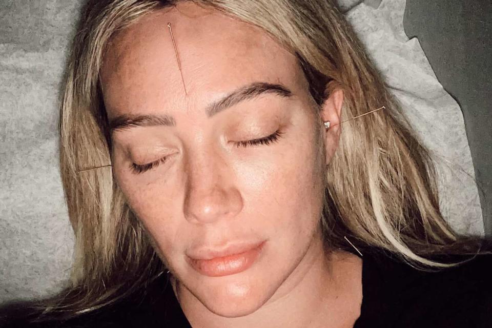 <p>Hilary Duff/Instagram</p> Hilary Duff getting acupuncture in a photo shared on April 16