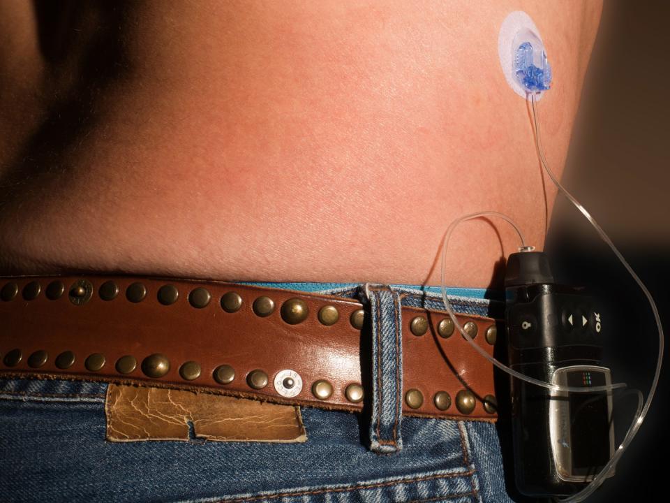 insulin pump