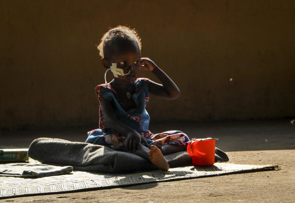 Two year old Akon Morro, who is anemic and suffers from edema due to malnutrition, sits on the floor of a feeding center in Al Sabah Children's Hospital in the capital Juba, South Sudan on Thursday, December 3, 2020.  / Credit: Sam Mednick / AP